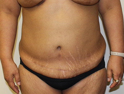 Tummy Tuck before and after - before