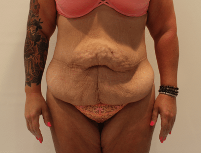 Tummy Tuck before and after - before