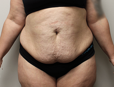 Tummy Tuck before and after - before