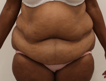 Tummy Tuck before and after - before