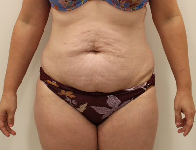 Tummy Tuck before and after - before