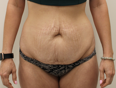 Tummy Tuck before and after - before