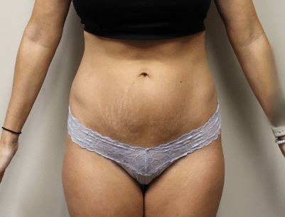 Tummy Tuck before and after - before