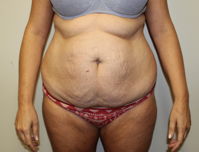 Tummy Tuck before and after - before