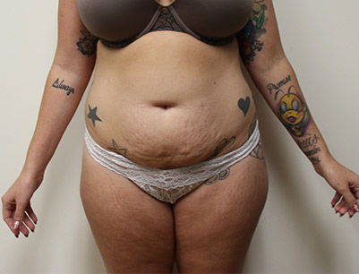 Tummy Tuck before and after - before