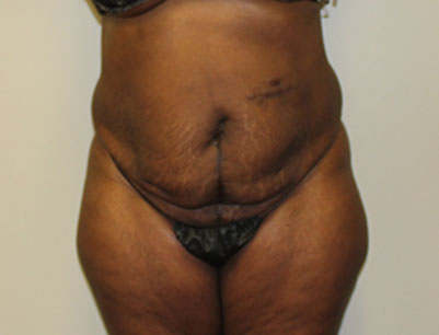 Tummy Tuck before and after - before