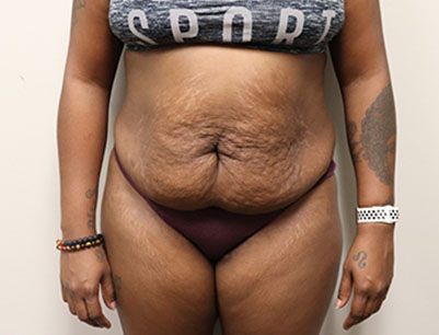 Tummy Tuck before and after - before