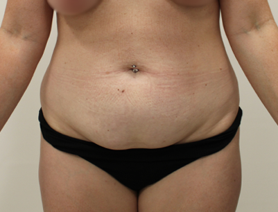 Tummy Tuck before and after - before