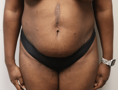 Tummy Tuck before and after - before