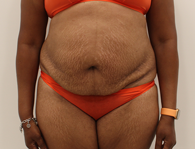 Tummy Tuck before and after - before