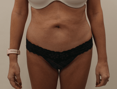 Tummy Tuck before and after - before