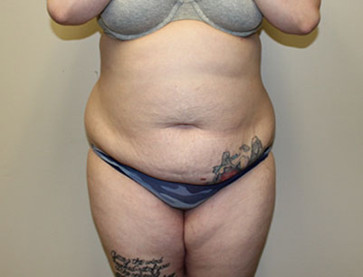 Tummy Tuck before and after - before