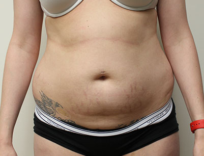 Liposuction before and after - before