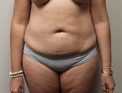 Tummy Tuck before and after - before