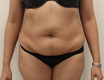 Tummy Tuck before and after - before