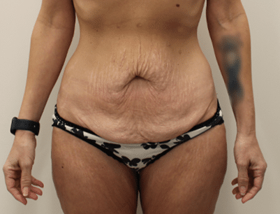 Tummy Tuck before and after - before