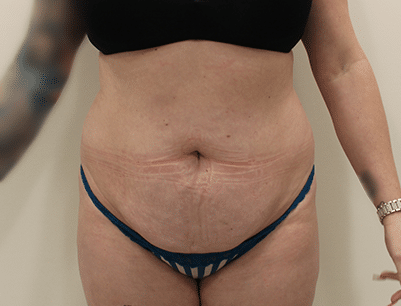 Tummy Tuck before and after - before