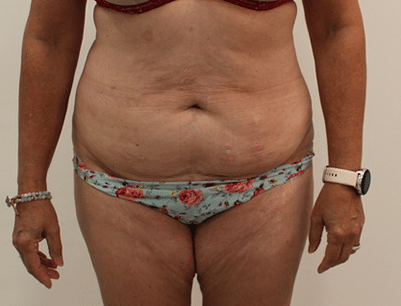 Tummy Tuck before and after - before