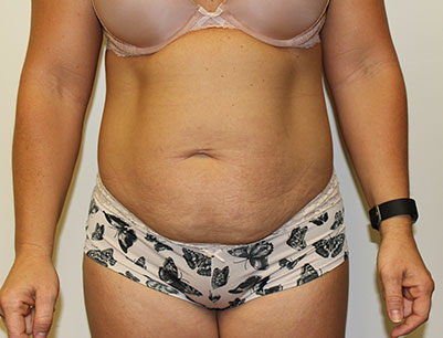 Tummy Tuck before and after - before