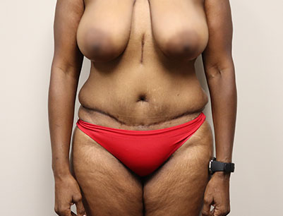 Tummy Tuck before and after - before
