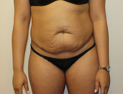 Tummy Tuck before and after - before