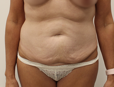 Tummy Tuck before and after - before
