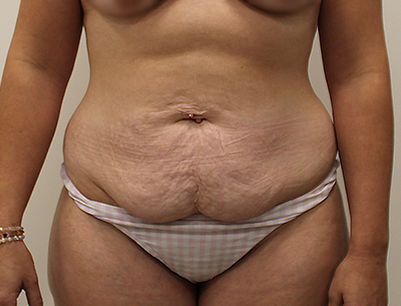 Tummy Tuck before and after - before