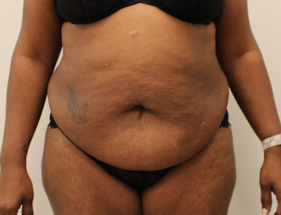 Tummy Tuck before and after - before