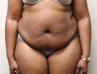 Tummy Tuck before and after - before