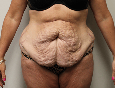 Tummy Tuck before and after - before