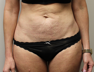Tummy Tuck before and after - before