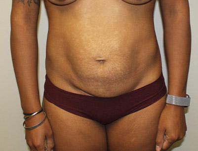 Tummy Tuck before and after - before