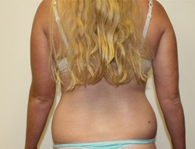 Liposuction before and after - before