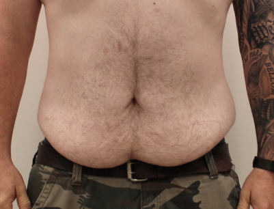 Tummy Tuck before and after - before