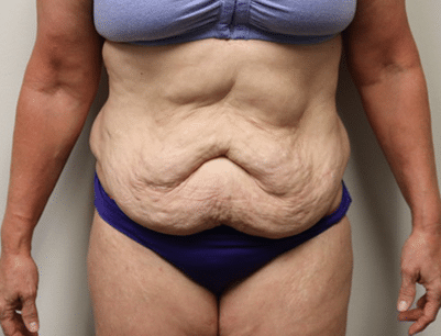 Tummy Tuck before and after - before