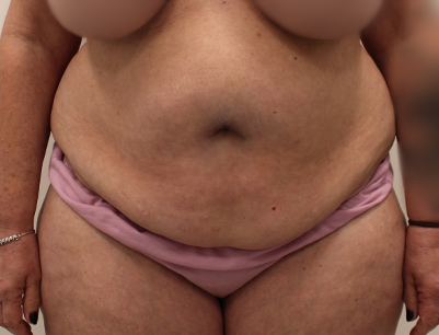 Tummy Tuck before and after - before