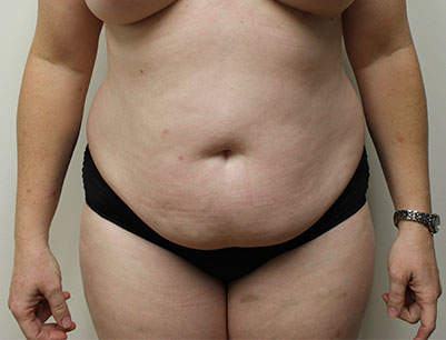 Tummy Tuck before and after - before