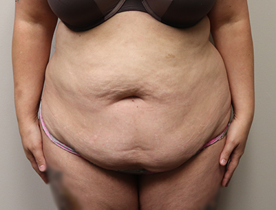 Tummy Tuck before and after - before