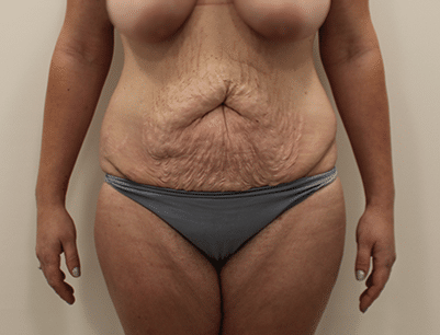 Tummy Tuck before and after - before