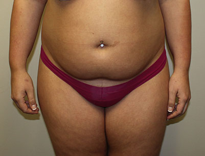 Liposuction before and after - before