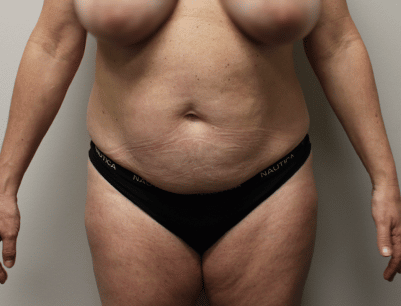 Tummy Tuck before and after - before