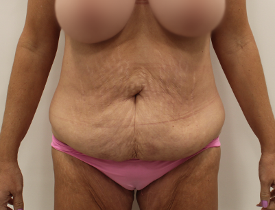 Tummy Tuck before and after - before