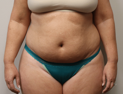 Tummy Tuck before and after - before
