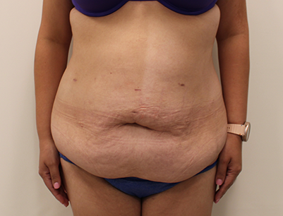 Tummy Tuck before and after - before