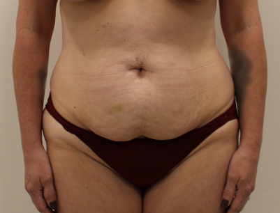 Tummy Tuck before and after - before