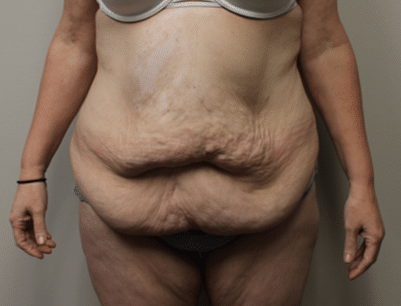 Tummy Tuck before and after - before