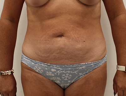 Tummy Tuck before and after - before