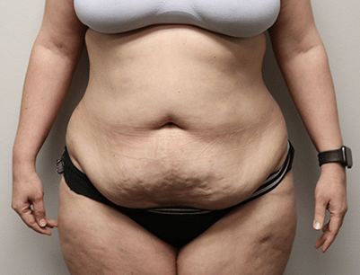 Tummy Tuck before and after - before