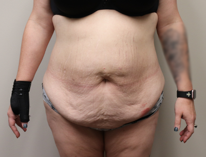 Tummy Tuck before and after - before