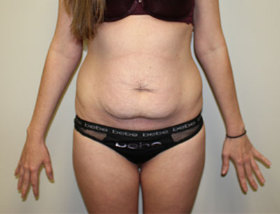 Tummy Tuck before and after - before